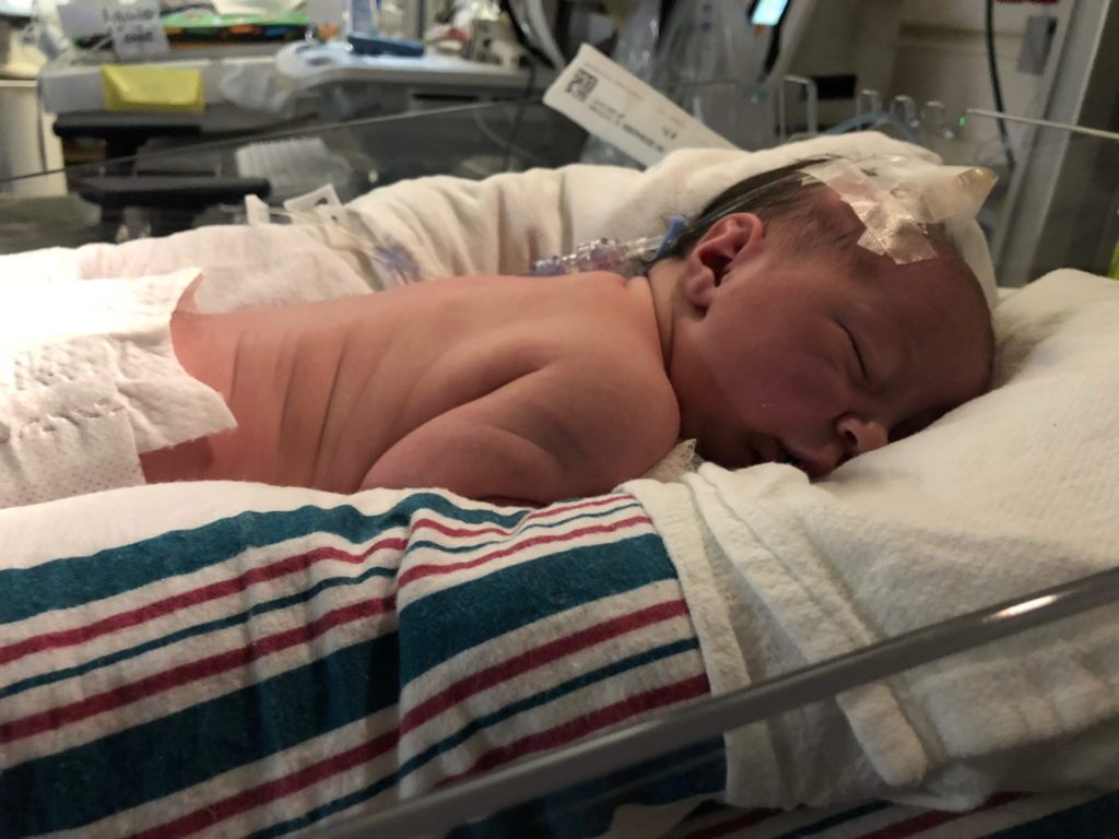 Newborn baby with Pierre Robin Sequence lying on her stomach in the NICU