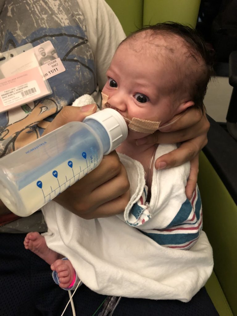 A newborn baby with Pierre Robin Sequence and cleft palate drinking from a bottle