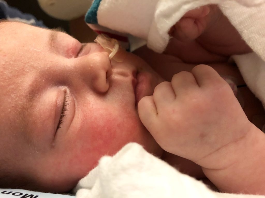 Very young baby with Pierre Robin Sequence sleeping in the NICU