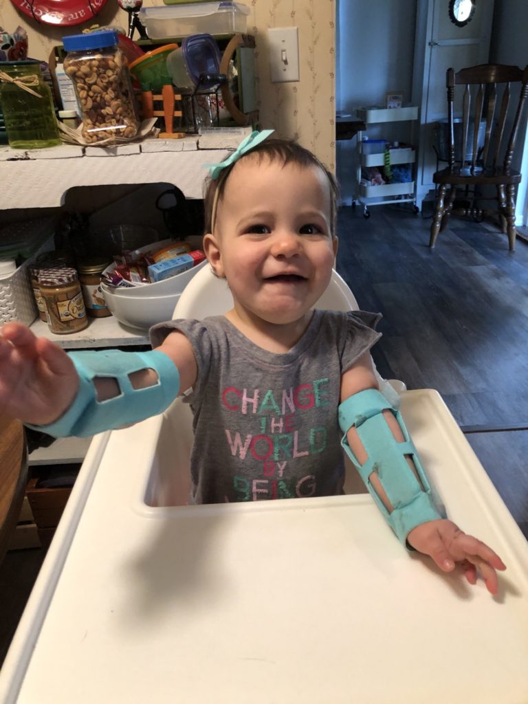 A baby sitting in a high chair wearing arm restraints after palate repair surgery